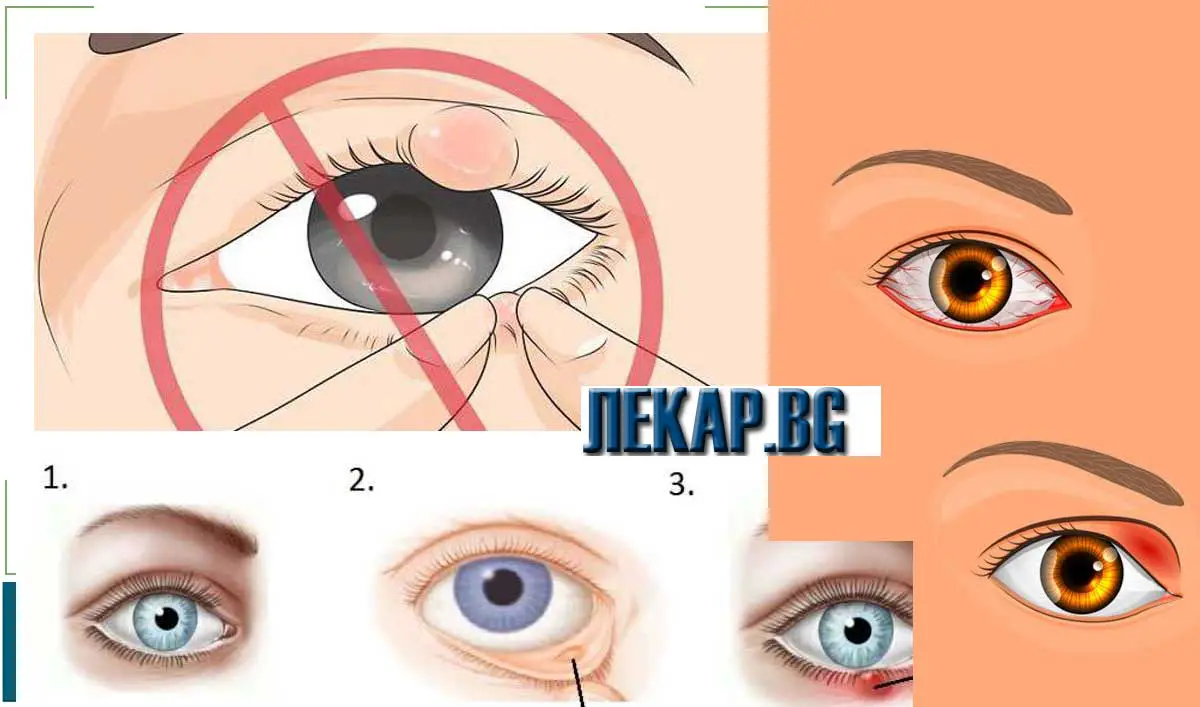 Ечемик на окото, лечение