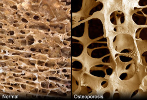 остеопороза