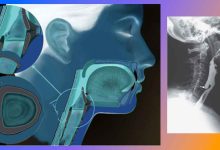 Спазъм на гълтача: Става въпрос за дивертикули на хранопровода, още известни като Дивертикул на Зенкер и Болест на Барсони-Полгар. Специалисти и клиники, цена на операция.