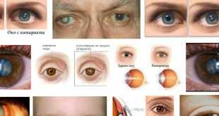 катаракта операция противопоказания