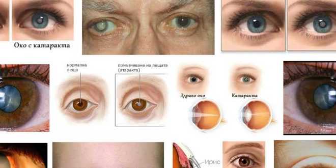 катаракта операция противопоказания