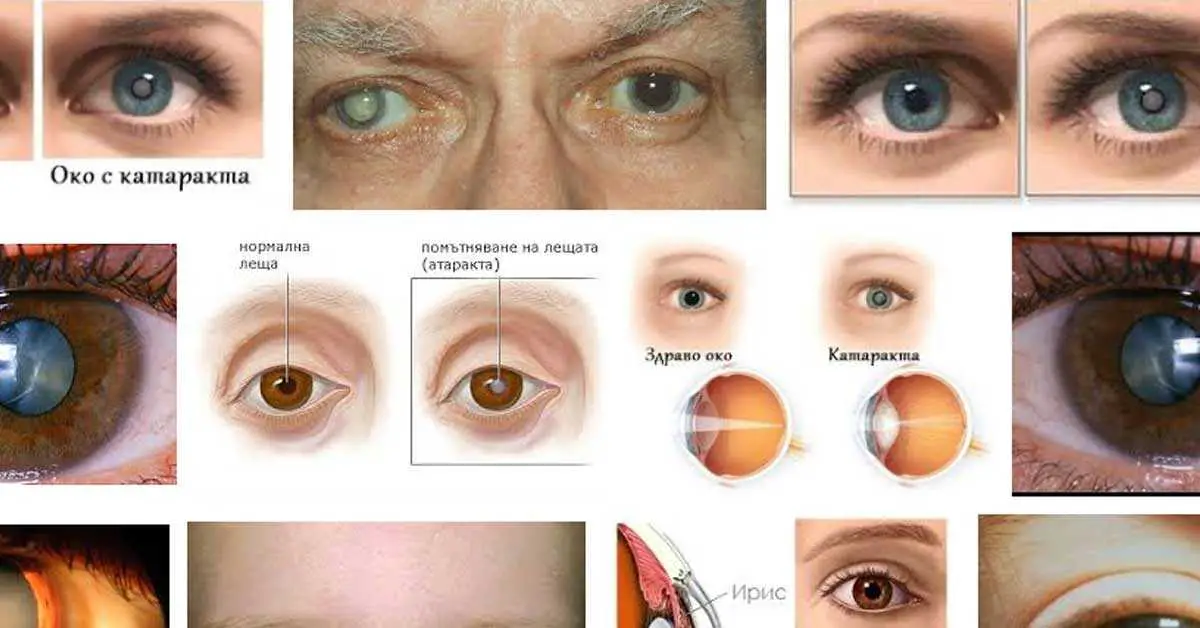 Что можно делать после катаракты. Катаракта глаза классификация. Катаракта до и после операции. Стадии развития катаракты.