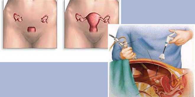 отстраняване на матката, премахване, хистеректомия