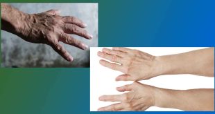 Какво да правим при спукана вена на пръст на ръката. Народен лек за хематом. Пукане на капиляри по пръстите на ръцете. Лечение на кръвоносни съдове на крака и др. Компреси, крем, лекарства.