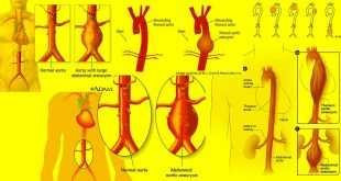 аневризма аорта aneurysm aorta