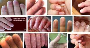 белене на кожата на пръстите на ръцете