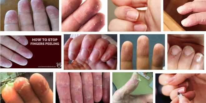 белене на кожата на пръстите на ръцете