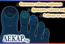 Гъбичната инфекция на ноктите на краката е един от онези проблеми, за които хората рядко говорят открито, но от които страдат мнозина.
