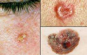Рак на кожата се разпознава по специфични белези