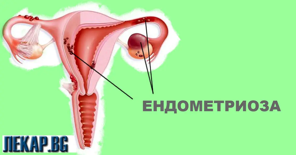 ендометриоза, лечение с билки и хомеопатия