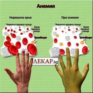 симптоми на анемия