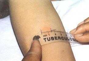 туберкулоза