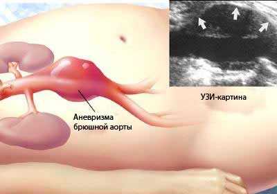 аневризма на аортата