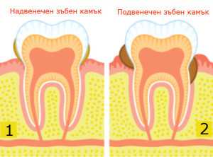 зъбен камък се почиства най-лесно при зъболекаря