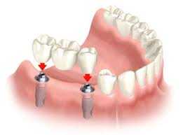 зъбни импланти