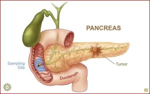 рак на панкреаса