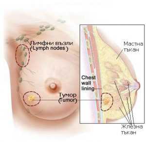 рак на гърдата