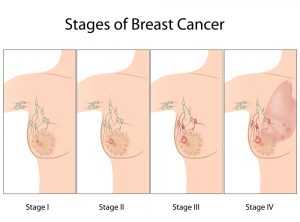 рак на гърдата
