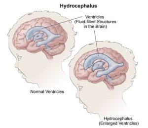 При хидроцефалия в мозъчните стомахчета се събира твърде много течност