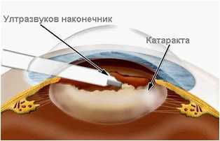 Лечението на катаракта разчита на модерни технологии