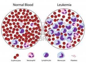 Увеличени лимфоцити при злокачествени заболявания на кръвта