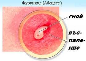 Цирей Лекарства Антибиотик Мехлеми Хирургия Изстискване