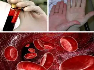 Симптоми на анемия и лечение