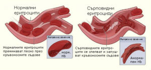 Сърповидно-клетъчна анемия и еритроцити