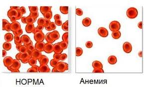 анемия хемоглобин, Апластична анемия, норма