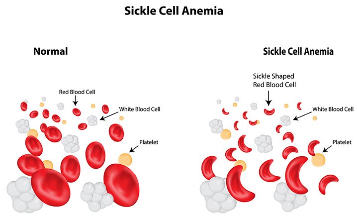 Сърповидно-клетъчна анемия лечение