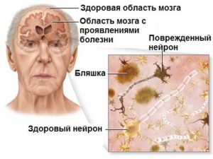 алцхаймер лечение, диагностика, тест