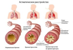 Бронхиална астма – пристъпи