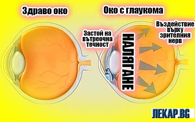 глаукома развитие на болестта
