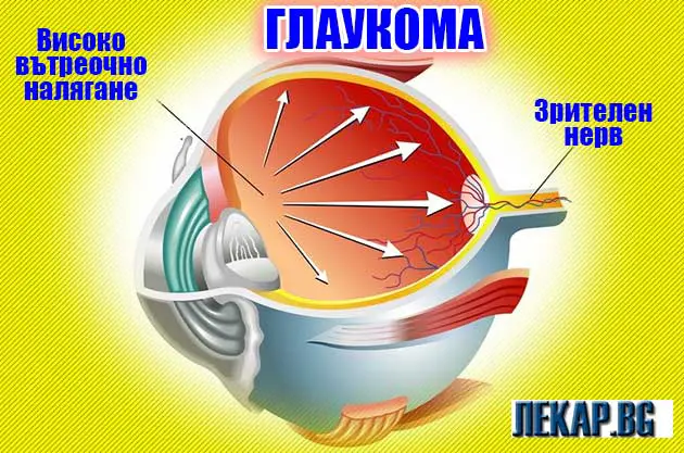 глаукома симптоми и лечение