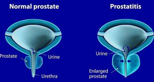 Проблеми с простатата - prostatit-04