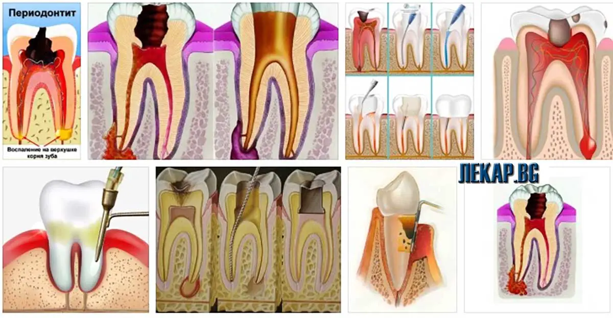 Лечение на клатещи се зъби с билки