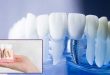 Зъбни импланти, цени ЕО дент