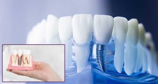 Зъбни импланти, цени ЕО дент